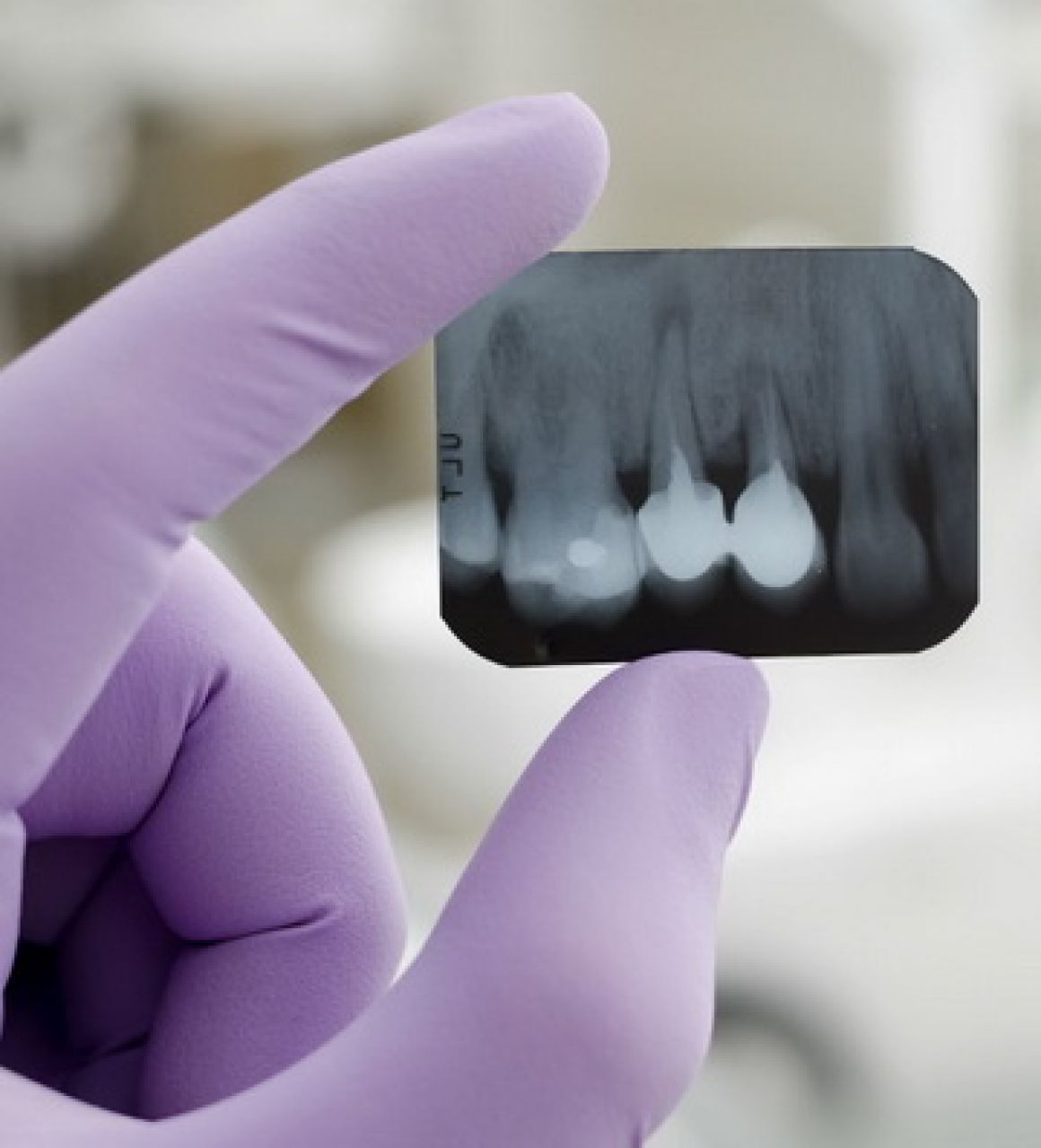 Рентген диагностика зубов